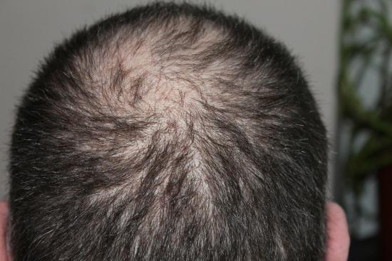 4 foods that could be causing hair loss